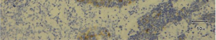 (b) Immunohistochemical staining shows that the tumor cells are positive for HMW-CK/34B and P63 in SCC.