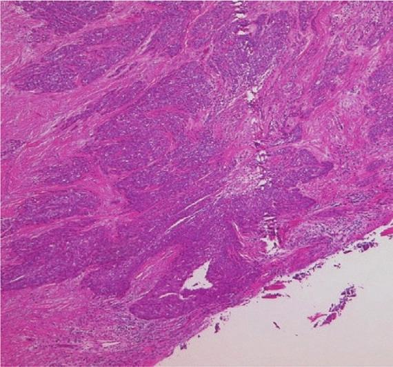 Case Reports in Dentistry 5 Figure 7: The histopathology of recurred resected specimen (HE 40, 100). Microscopically, the resected tumor of floor of mouth was SCC.