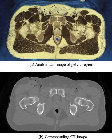 Prostate contouring is not easy Visible Human Project Normal male cadaver CT at 3 mm slices Anatomy slices at 1 mm Six experience