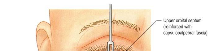 These structures are generally analogous to those of the upper eyelid. The orbicularis muscle is attached to the orbital rim via the orbicularis-retaining ligament.