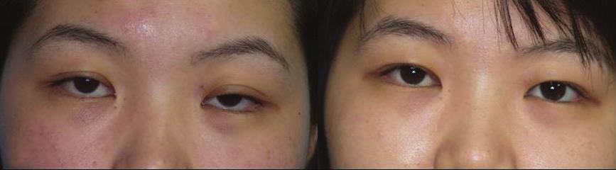 KH Kim, et al. Lower Eyelid Retraction Table 2. Causes of lower eyelid retraction Cause No. of eyelids (%) Congenital retraction 7 (36.8) After strabismus surgery * 4 (21.