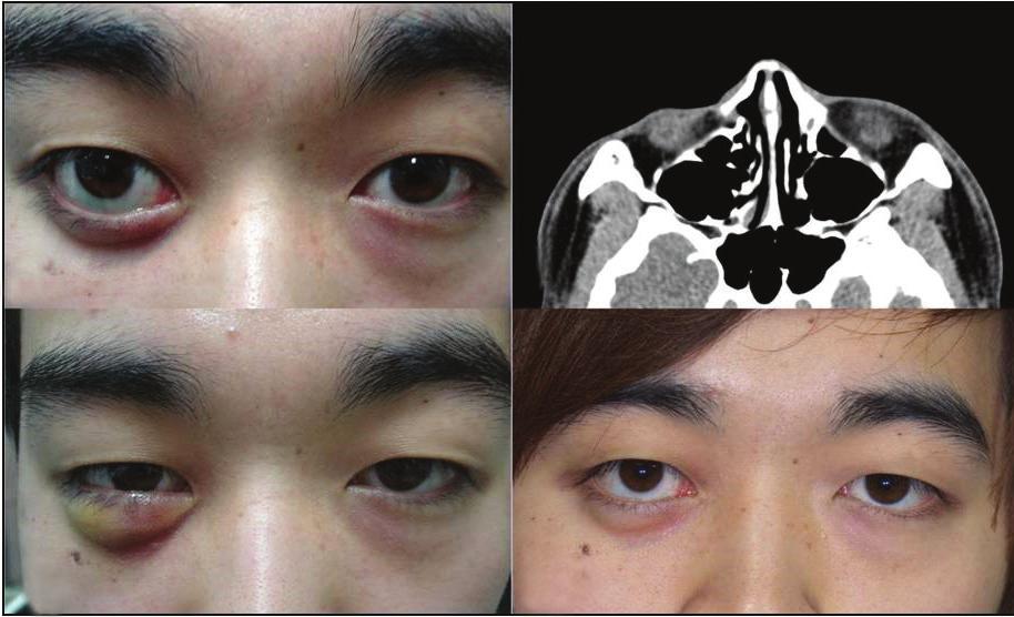 Korean J Ophthalmol Vol.31, No.4, 2017 Table 3. Causes of lower eyelid retraction and surgical procedure performed Case no.