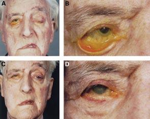 SOOF lift in chronic facial palsy 145 Figure 8 (A, B) Preoperative appearance of right long standing Bell s palsy with marked lower eyelid retraction and ptotic palpebral-malar ptosis.