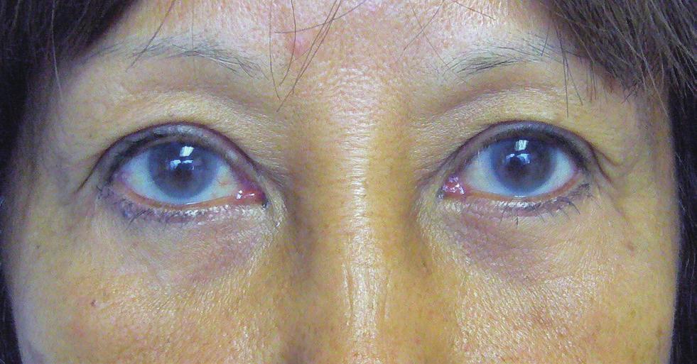Vol. 41 / No. 5 / September 2014 Fig. 5. Preoperative photograph Before photograph of a 58-year-old patient undergoing bilateral upper and lower blepharoplasties.