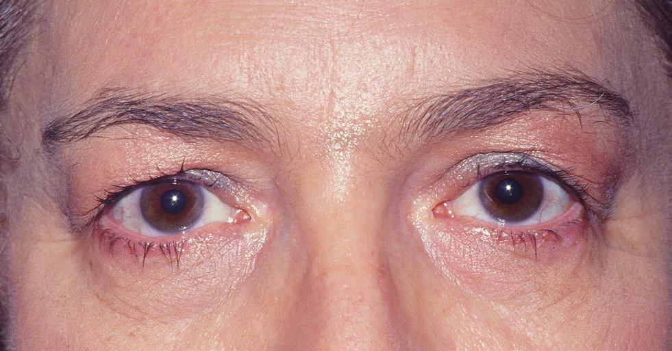 Concurrent lower blepharoplasties were also performed. This patient had no postoperative complications.