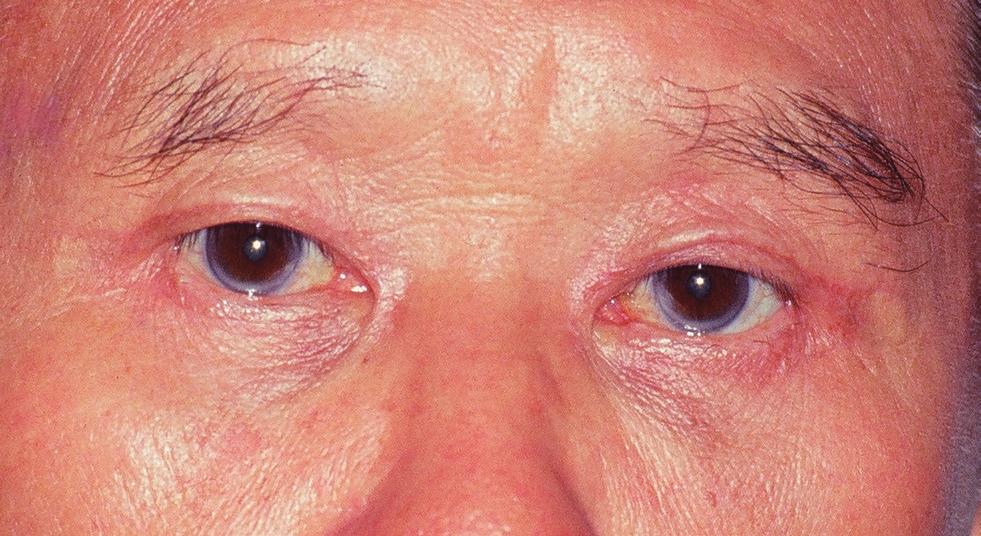 This group of seven patients with sluggish eyelid closure included four of the five patients (80%) who exhibited lagophthalmos of the ipsilateral eye postoperatively, and 5 of the 7 (72%) patients