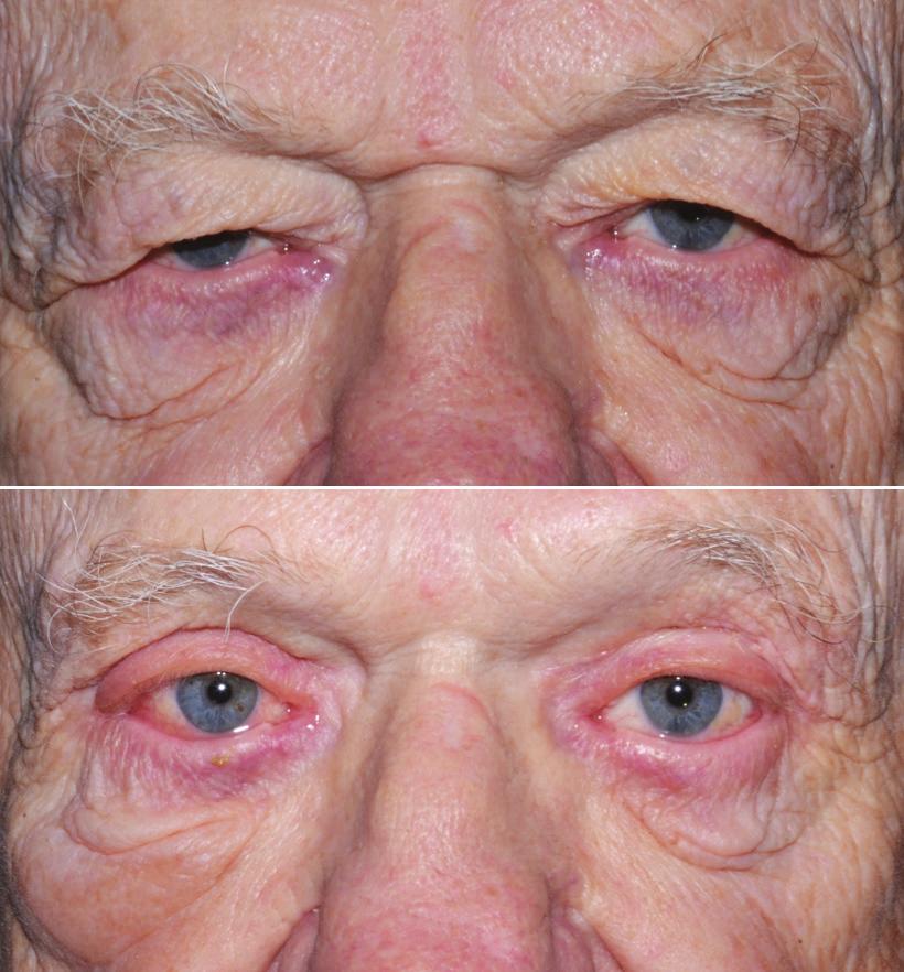B) 58-year-old male patient shown at post operative month 2 following one aesthetic unit surgery in the periorbital area and corrugators removal.