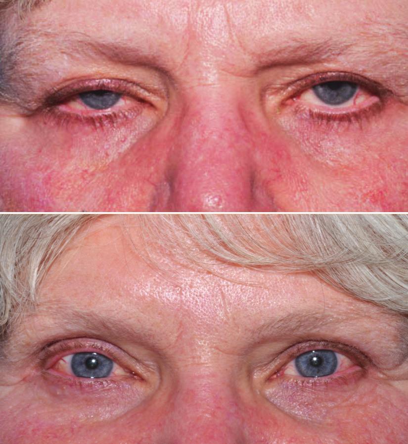 C) 65 -year-old female patient shown at post operative month 4, following one aesthetic unit surgery in the periorbital area and transconjunctival lower