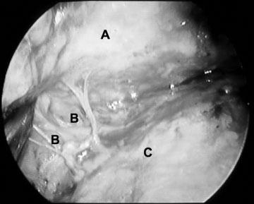 278 SEMINARS IN PLASTIC SURGERY/VOLUME 23, NUMBER 4 2009 Figure 6 Endoscopic view of the zygo-orbicular ligament (lower eyelid retaining ligament): A, zygo-orbicular ligament; B, sub-orbicularis