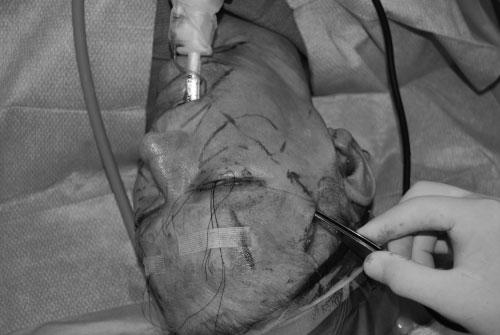 MANAGEMENT OF THE MIDFACE/TRUSSLER, BYRD 279 Figure 9 Intraoperative view of midface without point 1 elevation.