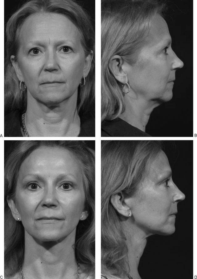 280 SEMINARS IN PLASTIC SURGERY/VOLUME 23, NUMBER 4 2009 Figure 11 (A, B) Preoperative photographs of patient 1, a 49-year-old woman demonstrating the typical upper and mid face changes including