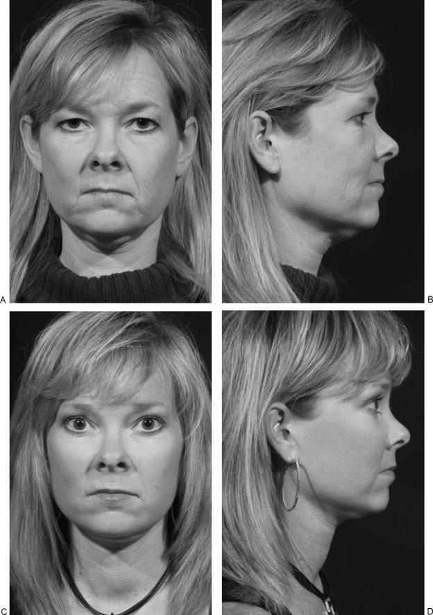 MANAGEMENT OF THE MIDFACE/TRUSSLER, BYRD 281 Figure 12 (A, B) Preoperative photographs of patient 2, a 39-year-old woman demonstrating the premature aging of the upper and mid face, including