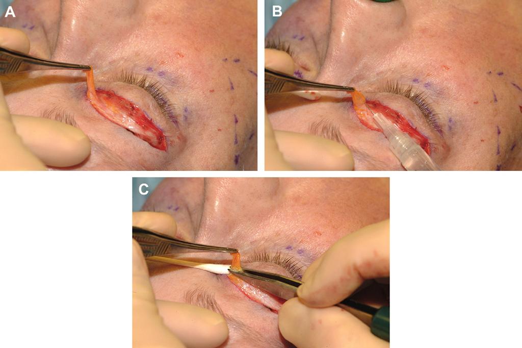 compartments is completed, bipolar electrocautery is used to ensure hemostasis before wound closure. The preferred technique for skin closure is as follows (Fig.