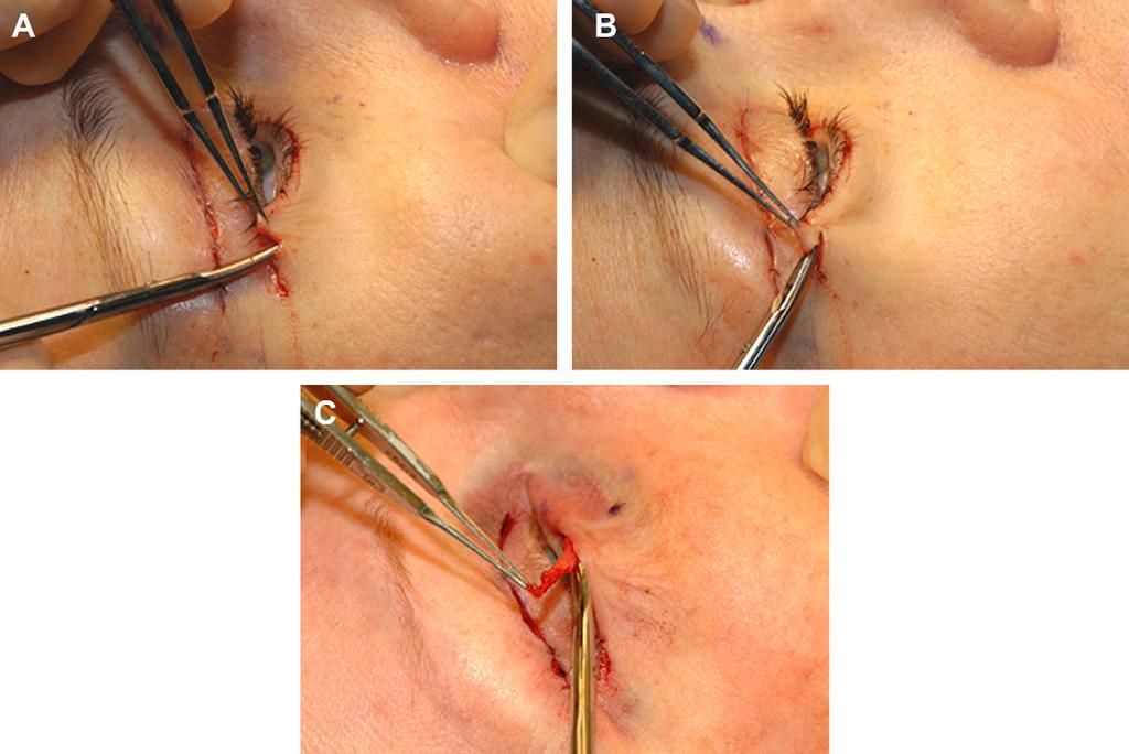 Following the skin incision, fine curved scissors are used to dissect through the orbicularis muscle at the lateral aspect of the incision, thus exposing the orbital septum.