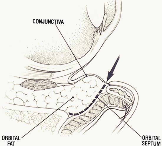 A tacking suture is placed to maintain the position of the skin-muscle flap; eyelid scissors are then used to excise the overlapping skin (Fig. 22B).