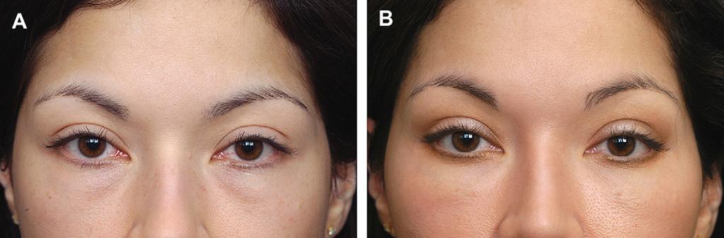 32 Batniji & Perkins Author's personal copy Fig. 26. Lower blepharoplasty via transconjunctival approach: (A) preoperatively and (B) postoperatively.