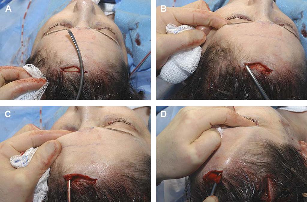22 Batniji & Perkins Author's personal copy Fig. 5. (A) The Ramirez EndoForehead A/M dissector (Snowden Pencer) is used to elevate the arcus marginalis at the level of the supraorbital rim.