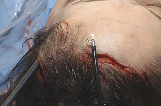 With a custom-made reusable electrode knife tip, the periosteum is incised in a horizontal direction at the level of the supraorbital rim (Fig. 8).