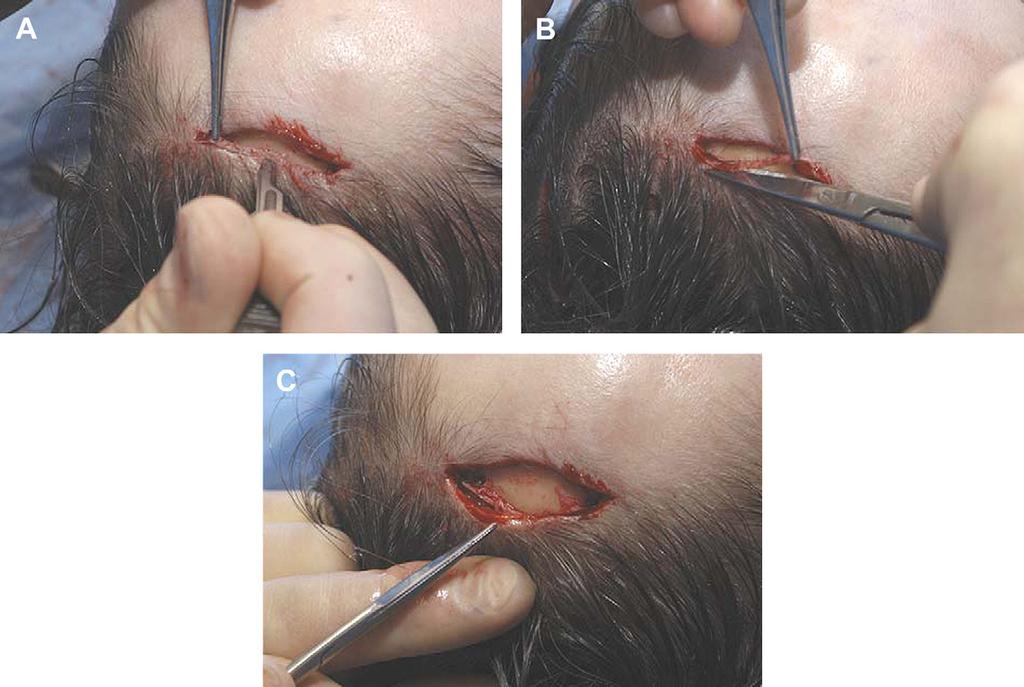 24 Author's personal copy Fig. 9. A 2- to 3-mm strip of epidermis from the posterior flap is excised. (A) A scalpel is used to make the incision through the epidermis.