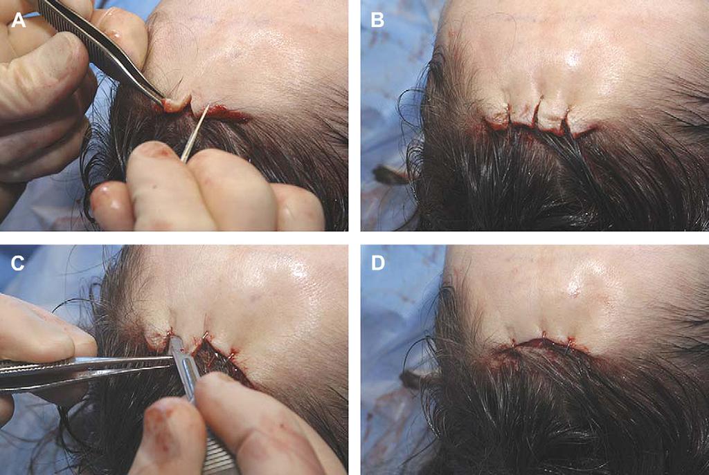 (C) The intact dermis, subcutaneous tissue, and hair follicles after removal of the epidermal layer. Fig. 10. Sequential resection of the anterior flap is performed.