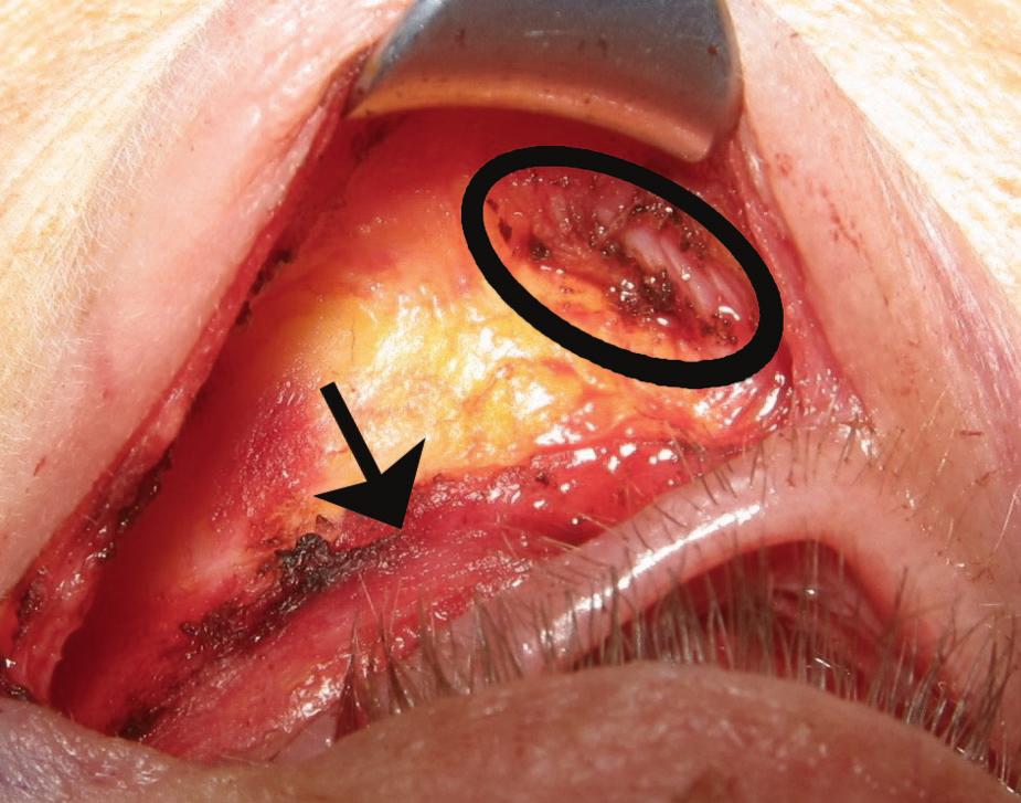 The fat pockets are infiltrated through the transconjunctival approach, and the suborbicularis plane is injected transcutaneously across the entire lid to 2 cm below the inferior orbital rim, at the
