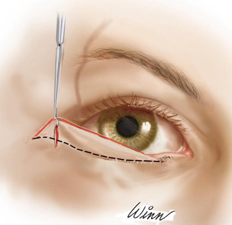 Volume 129, Number 4 Lower Eyelid and Cheek Rejuvenation Fig. 4. Conservative excision of redundant skin and orbicularis is performed with the carbon dioxide laser in two triangles based at or lateral to the lateral commissure.
