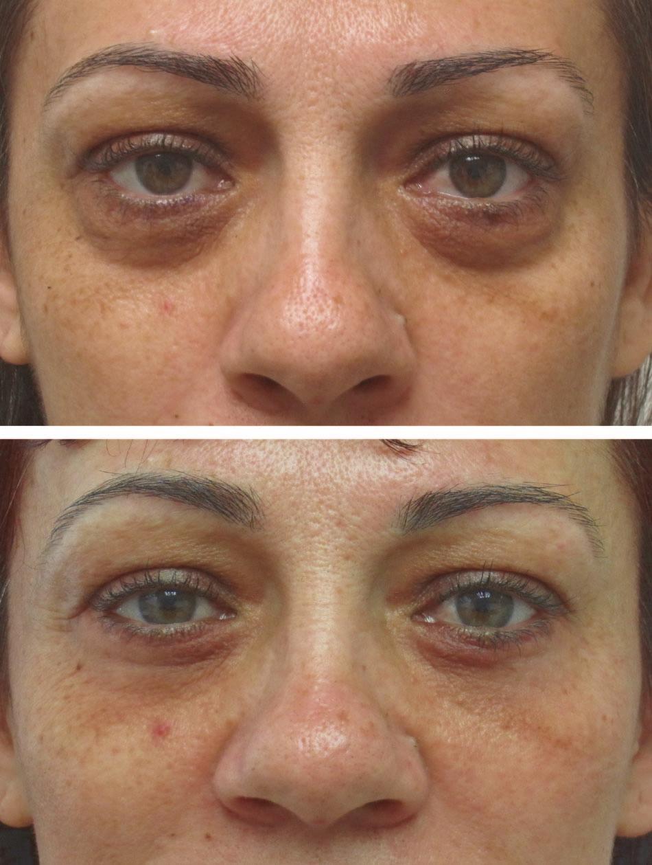 A 44-year-old woman with no orbital fat prolapsed is shown before and 6 months after extended lower blepharoplasty with lysis of the orbicularis retaining ligament and orbicularis oculi insertion,