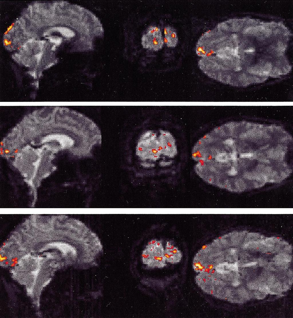 11 Fig. 2 Orthogonal sections of human brain showing regions activated by a visual stimulus.
