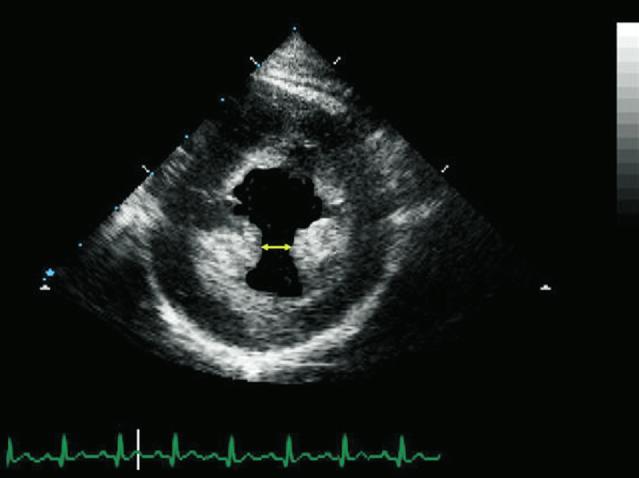 746 ROSHANALI ET AL Ann Thorac Surg IMR AFTER RING ANNULOPLASTY 2007;84:745 9 echocardiography (post-cpb TEE); 114 of these patients, whose acceptable postoperative results (0 or 1 MR) were later