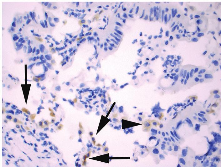 (arrows) seen in a case with NSCLC that is negative for a ROS1 gene rearrangement ( 400); (C) an example of ROS1 wild type invasive mucinous adenocarcinoma demonstrating weak cytoplasmic staining in