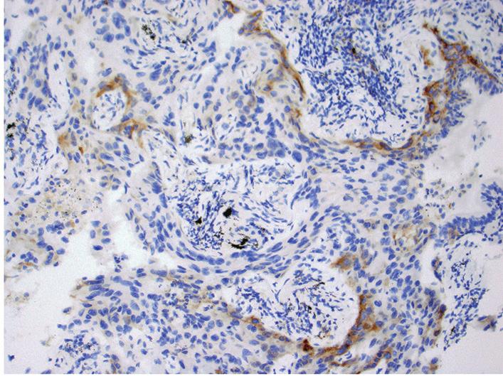 cell carcinoma, favor squamous cell carcinoma, exhibiting PD-L1 membranous staining on 50% of tumor cells (C, 100; D, 400).