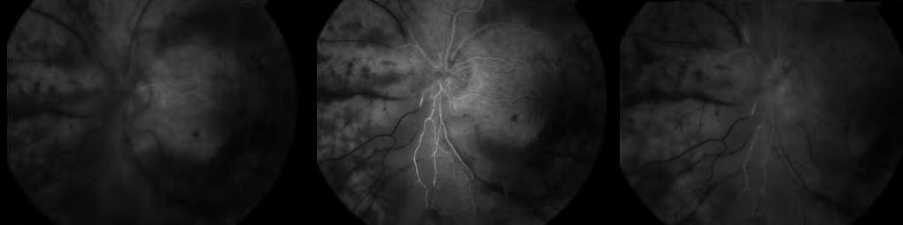 30 Figure 2. Fluorescein angiogram, left eye, day 3 of admission. Left to right: 35 sec; 2 min, 30 sec; 4 min. Note diffuse vasculitis with poor perfusion, and patchy staining of necrotic retina.