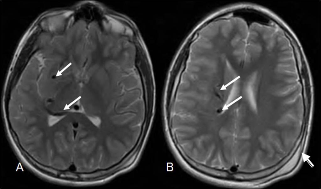 Figure 2: 12 year old male with right holohemispheric developmental venous anomaly (DVA). Select axial T1 MRI brain images. (Protocol: Pulse sequence; 2D Spin Echo, TR: 516.
