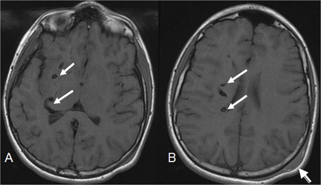 Post traumatic left parietal scalp hematoma (arrow head). Figure 3: 12 year old male with right holohemispheric developmental venous anomaly (DVA). Select axial MRI T2 brain images.