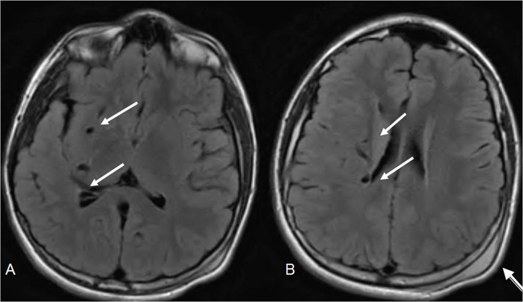 Figure 4: 12 year old male with right holohemispheric developmental venous anomaly (DVA). Select axial FLAIR MRI brain images. (Protocol: Pulse sequence; 2D FLAIR, TR: 516.