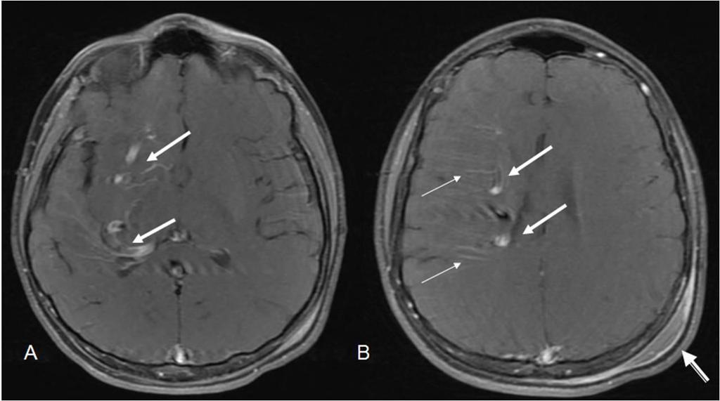 Post traumatic left parietal scalp hematoma (arrow head). Figure 5: 12 year old male with right holohemispheric developmental venous anomaly (DVA). Select axial T1 post contrast MRI brain images.