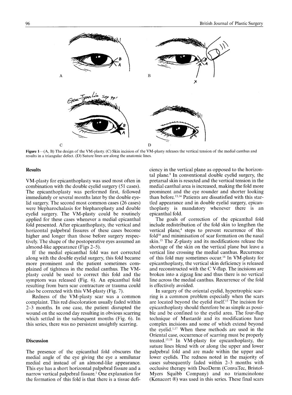 96 British Journal of Plastic Surgery,X D Figure l (A, B) The design of the VM-plasty.