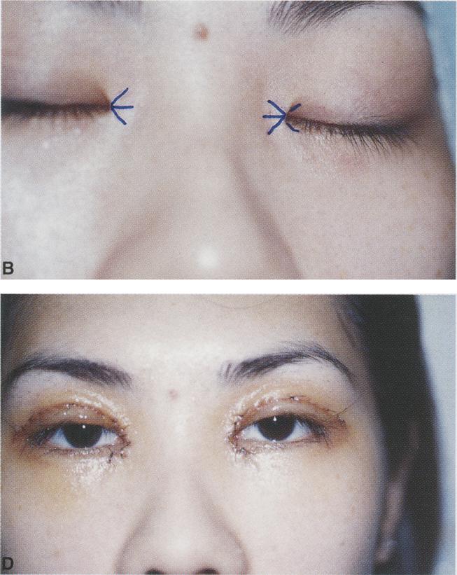 (C) Nasal skin pulled medially to show the C V-flap on the inner surface of the epicanthal fold, its limbs located along the upper and lower eyelid border.