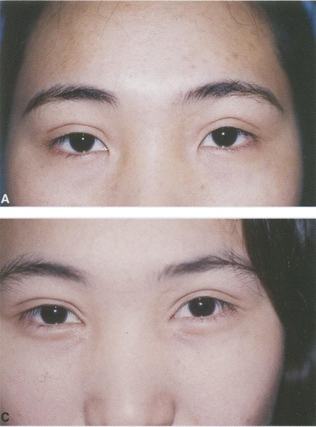 (B) Postoperative view 2 months after VM-plasty for epicanthoplasty, upper eyelid
