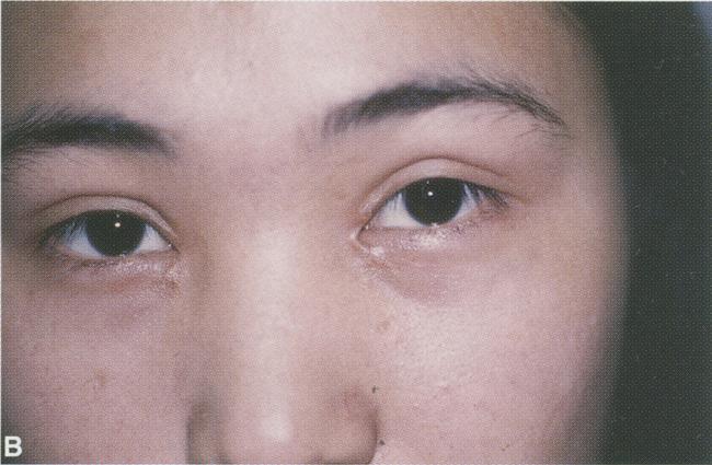 Figure 6--(A) Young woman dissatisfied after double eyelid surgery without
