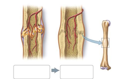 Bone Fractures are Healed by Fibroblasts and Osteoblasts Formation of bony callus Bone remodeling New blood vessels Bony Healed