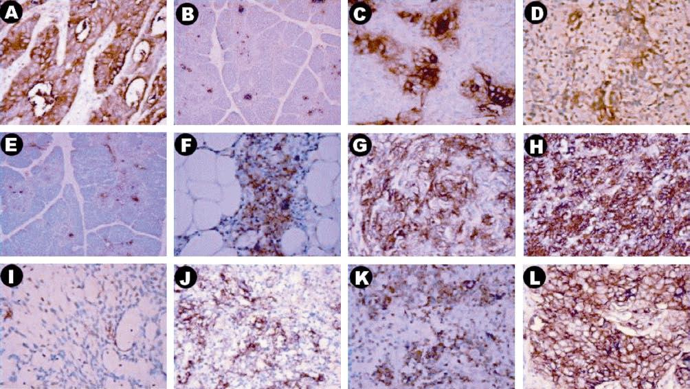Akyol & Üner The immunohistochemical profiles of CD and CEA expression of thymic epithelial neoplasms are demonstrated in table.
