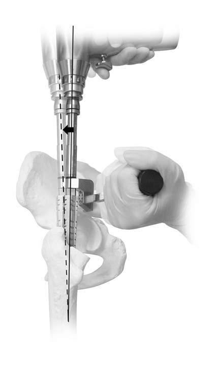Natural-Hip System Surgical Technique Femoral Reaming Instruments used: Natural-Hip Reamers or Natural-Hip Premier Press-fit Reamers Universal Zimmer Detachable Fitting Natural-Hip Reamer Stop and