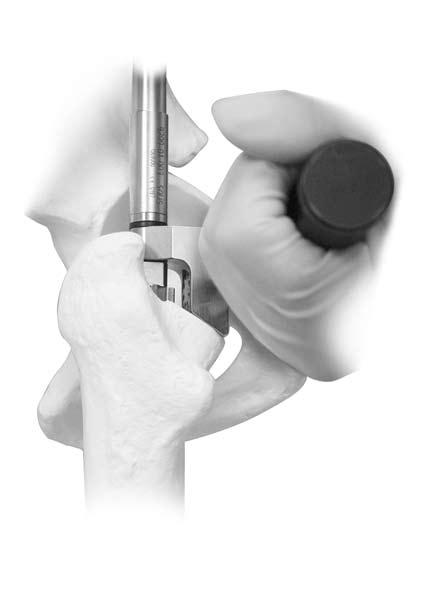 Fitting to allow for power reaming. The Natural-Hip Reamer Stop and Handle have a left/ right configuration with a calcar stop to ensure proper reaming depth.
