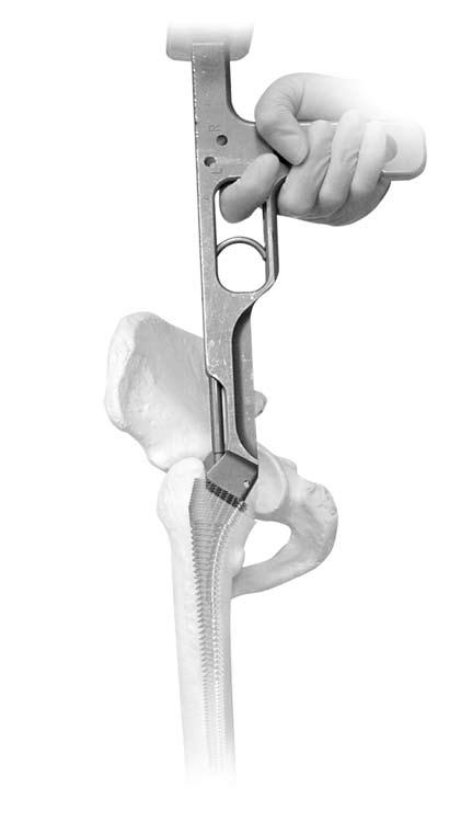 Natural-Hip System Surgical Technique Femoral Broaching Instruments used: Fully-toothed Natural-Hip Broaches or Natural-Hip Premier Press-fit Broaches Universal Trigger Broach Holder Mallet Alignment