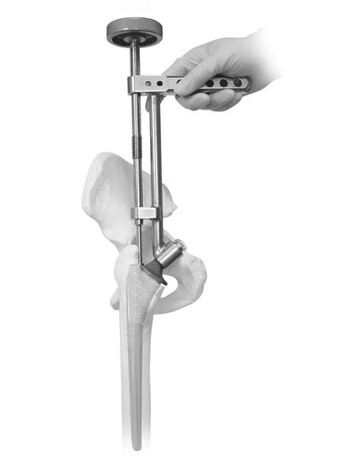 14 Natural-Hip System Surgical Technique Position the stem laterally toward the greater trochanter in an anteverted position by aligning the posterior face of the stem parallel to the posterior