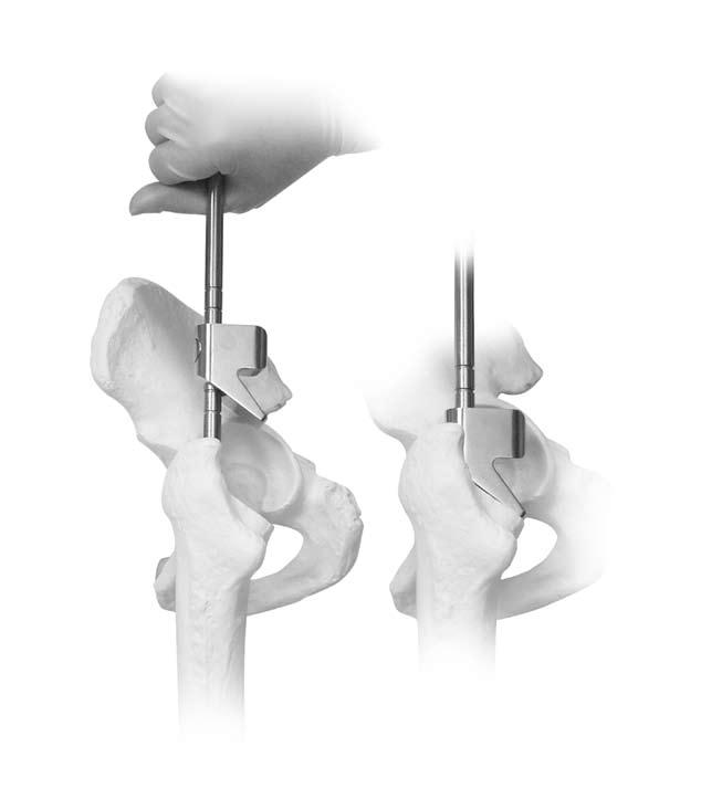 Natural-Hip System Surgical Technique 15 Cemented Technique For cemented implantation, the Natural-Hip sizes are designed to correspond to the Natural-Hip Reamers and Broaches while achieving