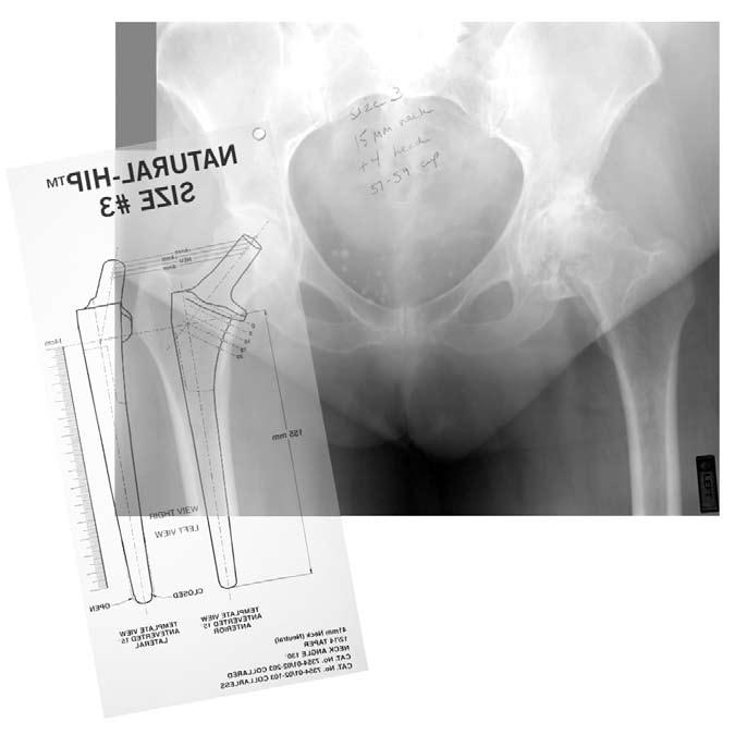 Natural-Hip System Surgical Technique Note: The Natural-Hip System templates incorporate 15 of neck anteversion for greater accuracy when using typical A/P and lateral radiographs.