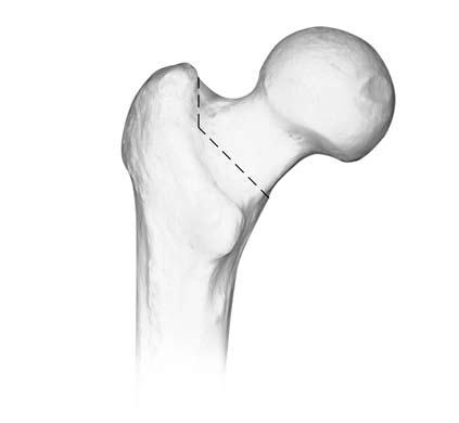 Natural-Hip System Surgical Technique Osteotomy of the Femoral Neck Instruments used: Universal Femoral Neck Osteotomy Guide Oscillating saw Hold the leg in internal rotation by flexing the knee 90