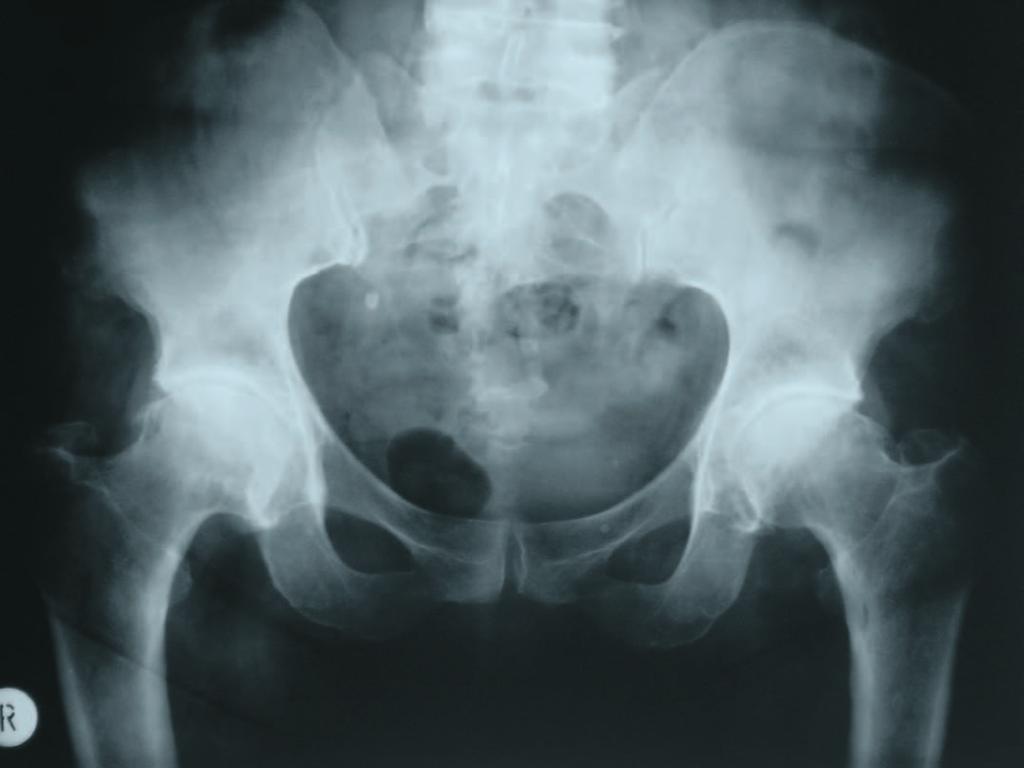 Moreover, the Allofit cup can be used in the case of primary hip dysplasia